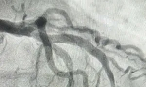 Nhồi máu cơ tim bởi thói quen hút thuốc 'giảm căng thẳng' Nhồi máu cơ tim bởi thói quen hút thuốc 'giảm căng thẳng'
