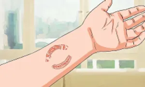 Vết thương do người cắn gây lây nhiễm bệnh gì? Vết thương do người cắn gây lây nhiễm bệnh gì?